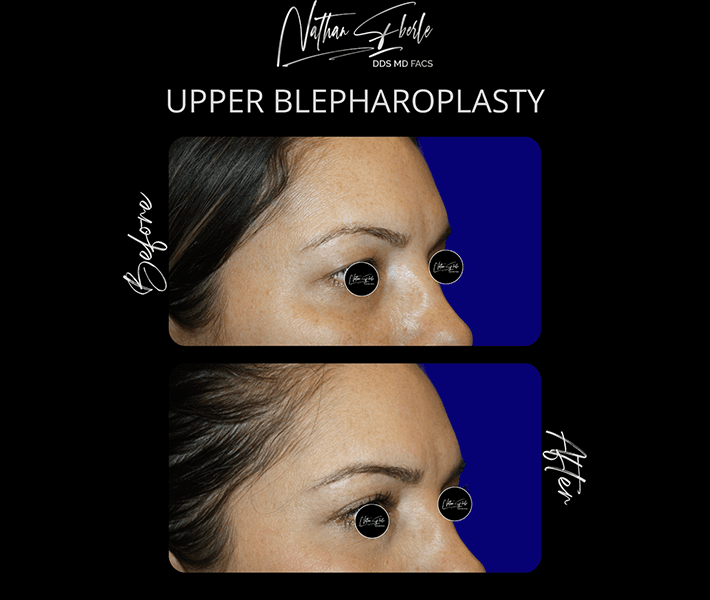Blepharoplasty before and after case 1, actual patient at Weston Center for Plastic Surgery