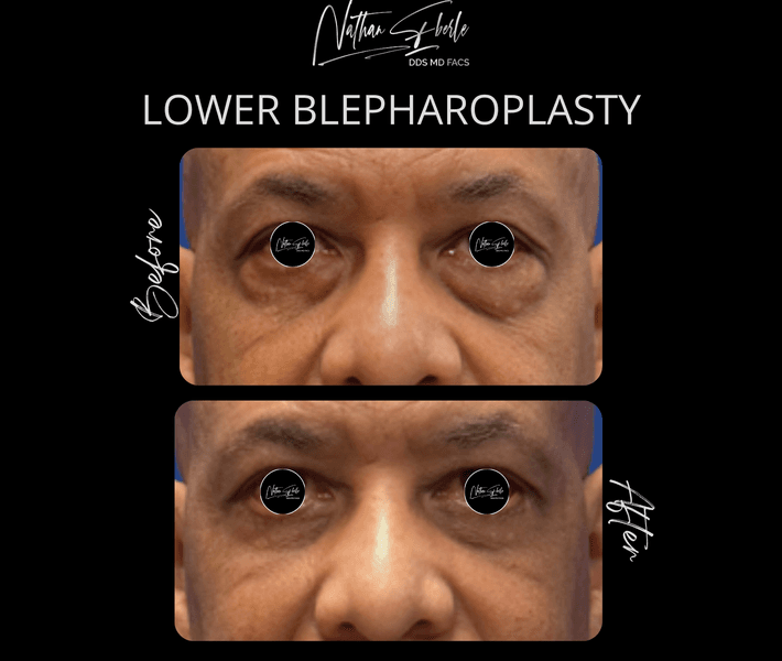 Blepharoplasty before and after case 22, actual patient at Weston Center for Plastic Surgery