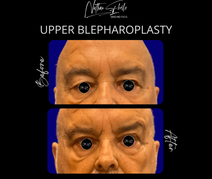 Blepharoplasty before and after case 23, actual patient at Weston Center for Plastic Surgery