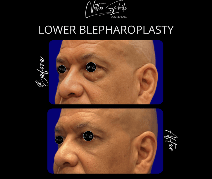 Blepharoplasty before and after case 24, actual patient at Weston Center for Plastic Surgery