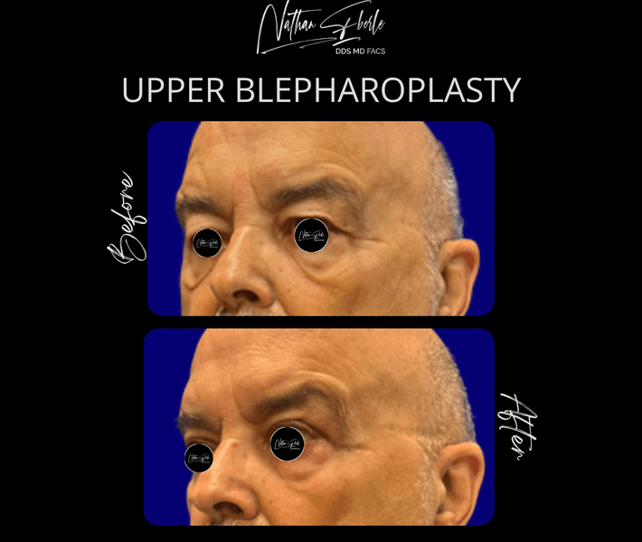 Blepharoplasty before and after case 25, actual patient at Weston Center for Plastic Surgery