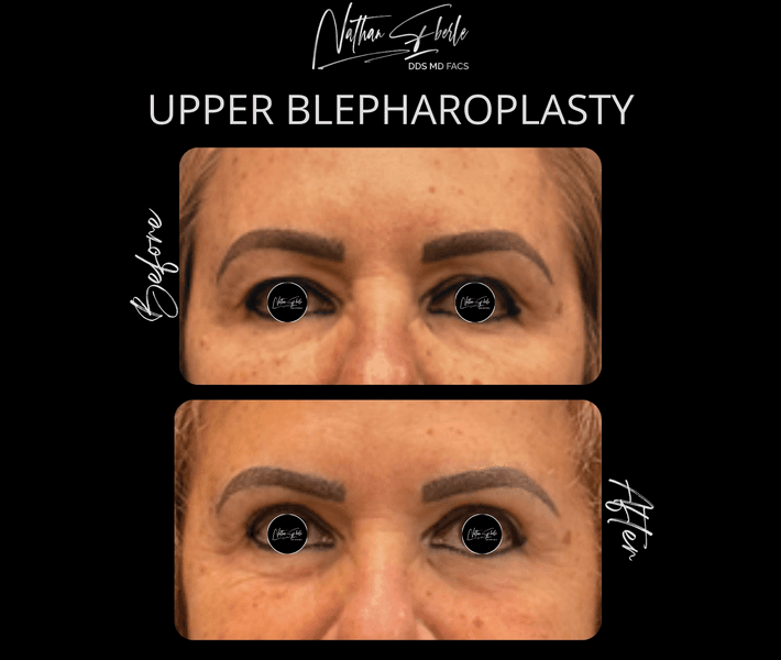 Blepharoplasty before and after case 26, actual patient at Weston Center for Plastic Surgery
