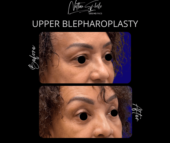 Blepharoplasty before and after case 27, actual patient at Weston Center for Plastic Surgery