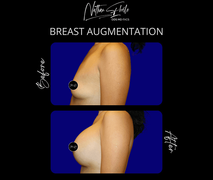 Breast Augmentation before and after case 102, actual patient at Weston Center for Plastic Surgery