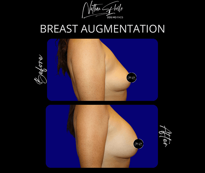 Breast Augmentation before and after case 115, actual patient at Weston Center for Plastic Surgery