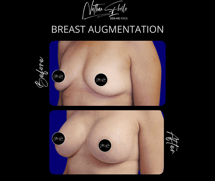 Breast Augmentation before and after case 129, actual patient at Weston Center for Plastic Surgery