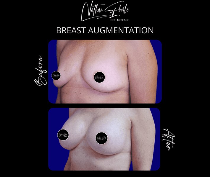 Breast Augmentation before and after case 165, actual patient at Weston Center for Plastic Surgery