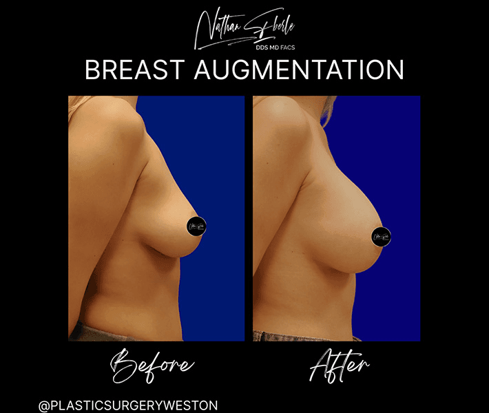 Breast Augmentation before and after case 238, actual patient at Weston Center for Plastic Surgery