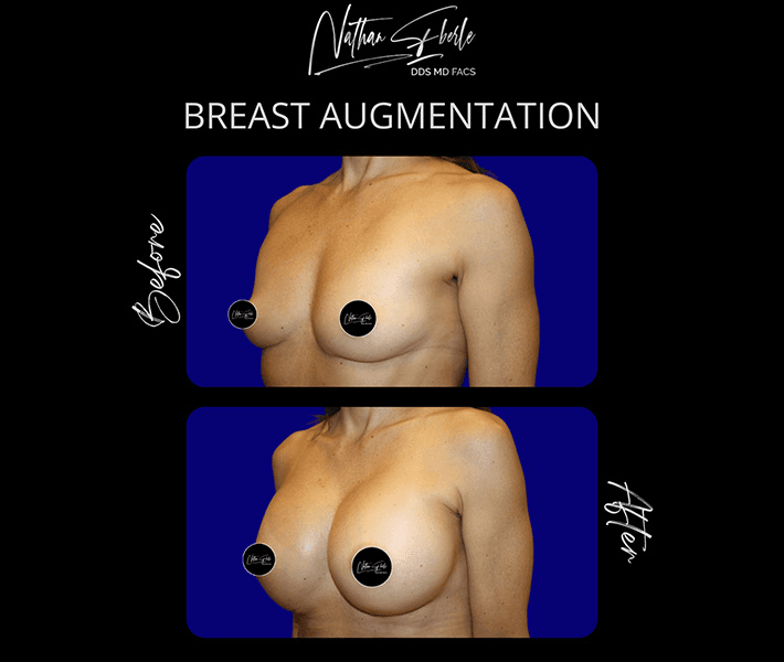 Breast Augmentation before and after case 242, actual patient at Weston Center for Plastic Surgery