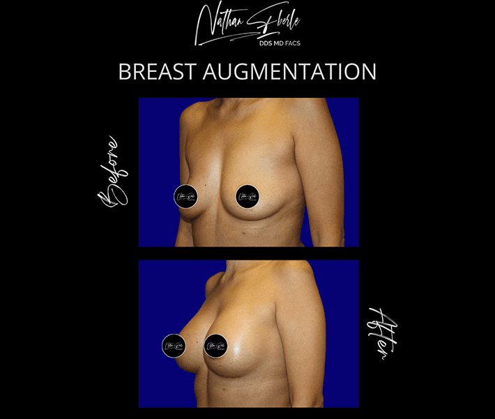 Breast Augmentation before and after case 249, actual patient at Weston Center for Plastic Surgery