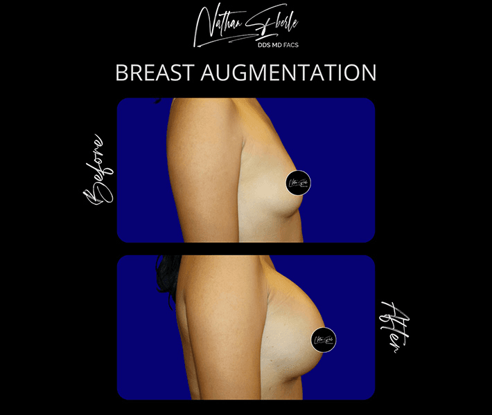Breast Augmentation before and after case 258, actual patient at Weston Center for Plastic Surgery