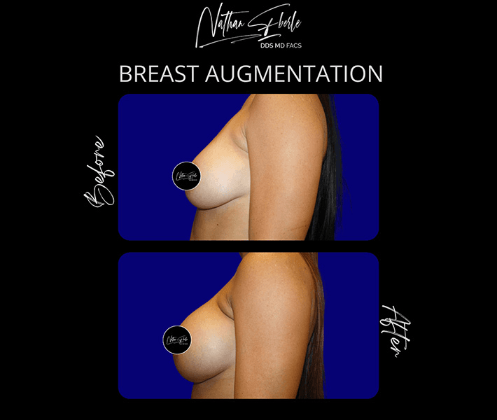 Breast Augmentation before and after case 259, actual patient at Weston Center for Plastic Surgery