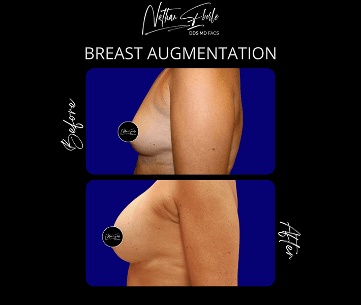 Breast Augmentation before and after case 260, actual patient at Weston Center for Plastic Surgery