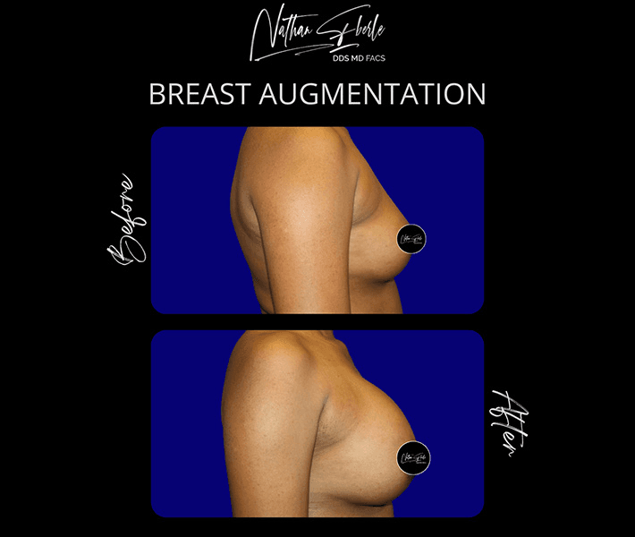 Breast Augmentation before and after case 261, actual patient at Weston Center for Plastic Surgery