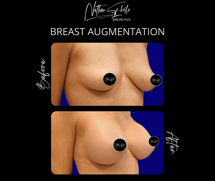 Breast Augmentation before and after case 265, actual patient at Weston Center for Plastic Surgery