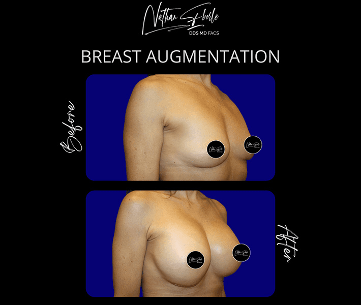 Breast Augmentation before and after case 266, actual patient at Weston Center for Plastic Surgery