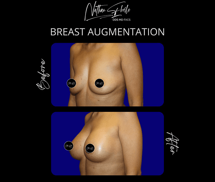 Breast Augmentation before and after case 273, actual patient at Weston Center for Plastic Surgery