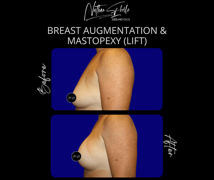 Breast Augmentation before and after case 279, actual patient at Weston Center for Plastic Surgery