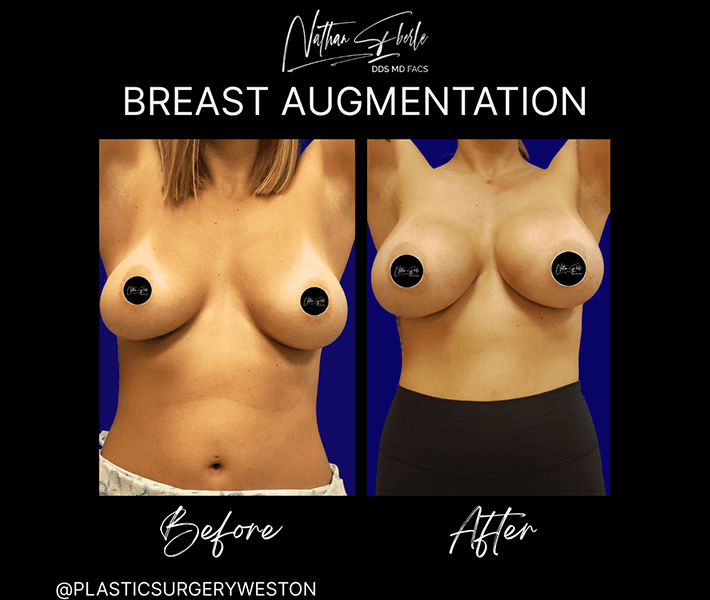 Breast Augmentation before and after case 288, actual patient at Weston Center for Plastic Surgery