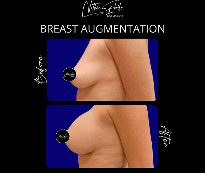 Breast Augmentation before and after case 304, actual patient at Weston Center for Plastic Surgery