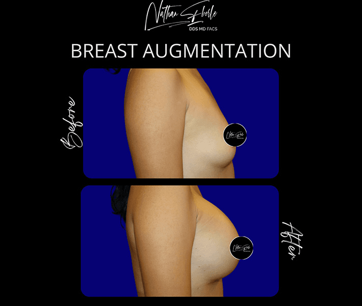 Breast Augmentation before and after case 305, actual patient at Weston Center for Plastic Surgery