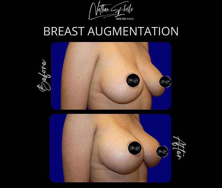 Breast Augmentation before and after case 307, actual patient at Weston Center for Plastic Surgery