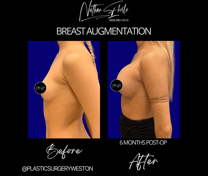 Breast Augmentation before and after case 32, actual patient at Weston Center for Plastic Surgery