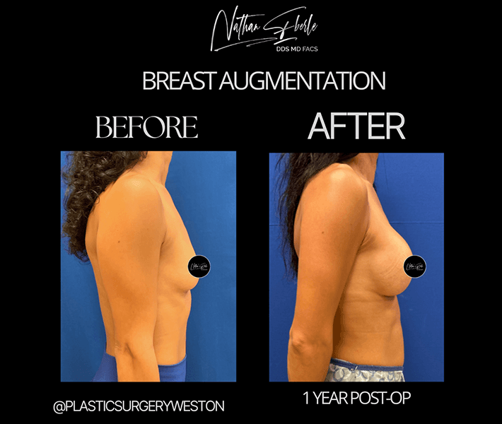 Breast Augmentation before and after case 52, actual patient at Weston Center for Plastic Surgery