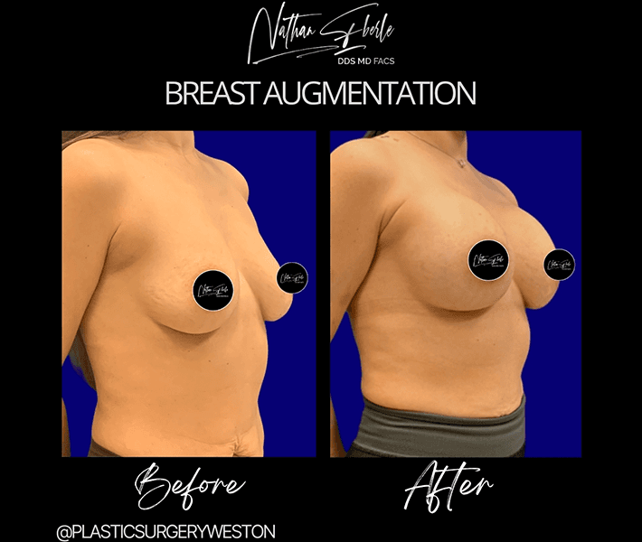 Breast Augmentation before and after case 75, actual patient at Weston Center for Plastic Surgery