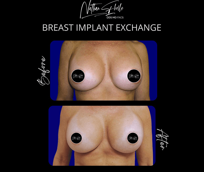 Breast Augmentation before and after case 96, actual patient at Weston Center for Plastic Surgery
