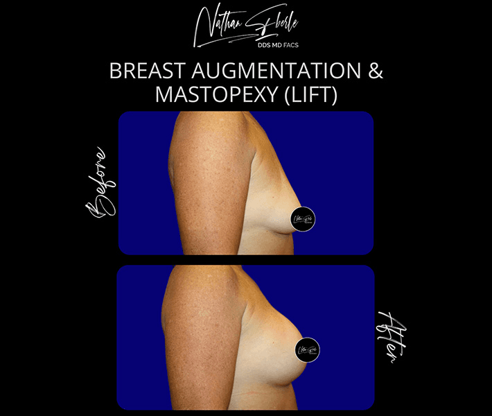 Breast Lift before and after case 10, actual patient at Weston Center for Plastic Surgery