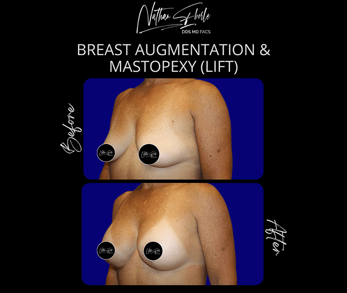 Breast Lift before and after case 11, actual patient at Weston Center for Plastic Surgery