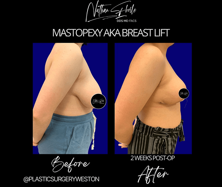 Breast Lift before and after case 14, actual patient at Weston Center for Plastic Surgery