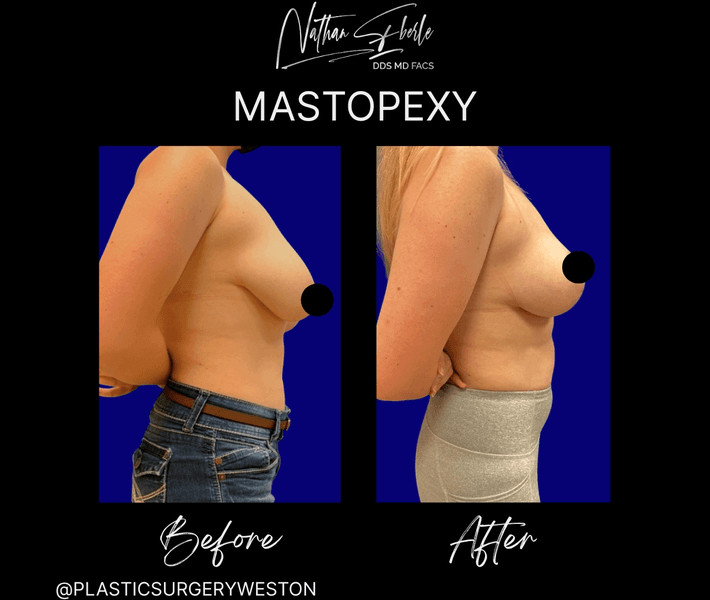 Breast Lift before and after case 16, actual patient at Weston Center for Plastic Surgery