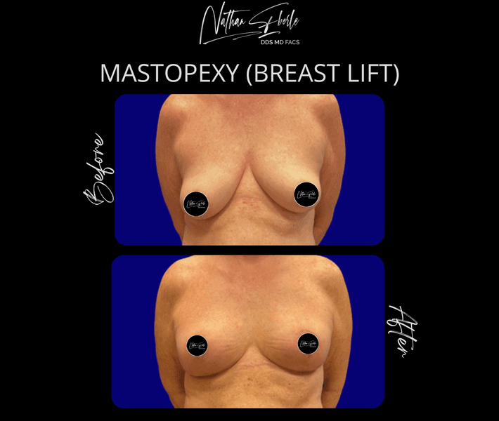 Breast Lift before and after case 17, actual patient at Weston Center for Plastic Surgery