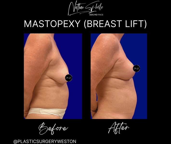 Breast Lift before and after case 18, actual patient at Weston Center for Plastic Surgery