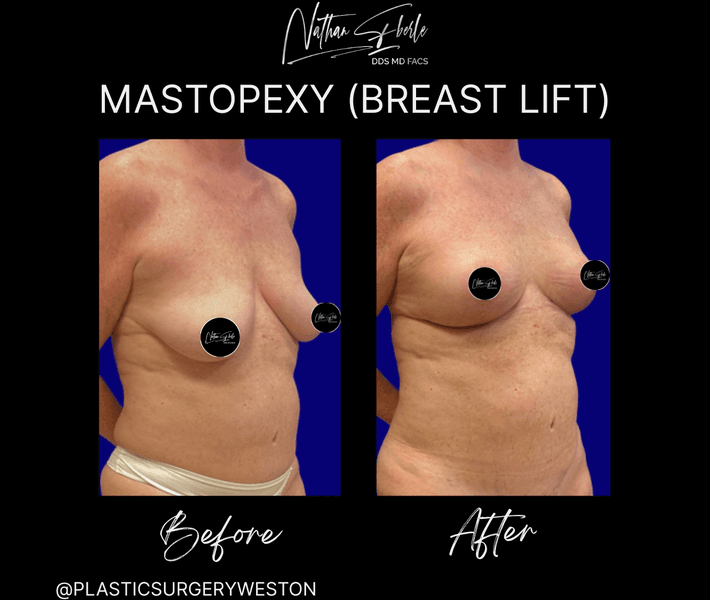 Breast Lift before and after case 19, actual patient at Weston Center for Plastic Surgery