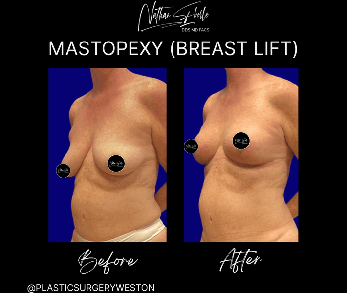 Breast Lift before and after case 20, actual patient at Weston Center for Plastic Surgery
