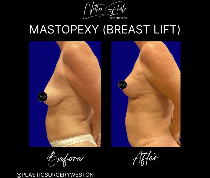 Breast Lift before and after case 21, actual patient at Weston Center for Plastic Surgery