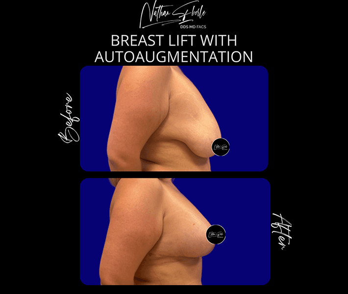 Breast Lift before and after case 22, actual patient at Weston Center for Plastic Surgery