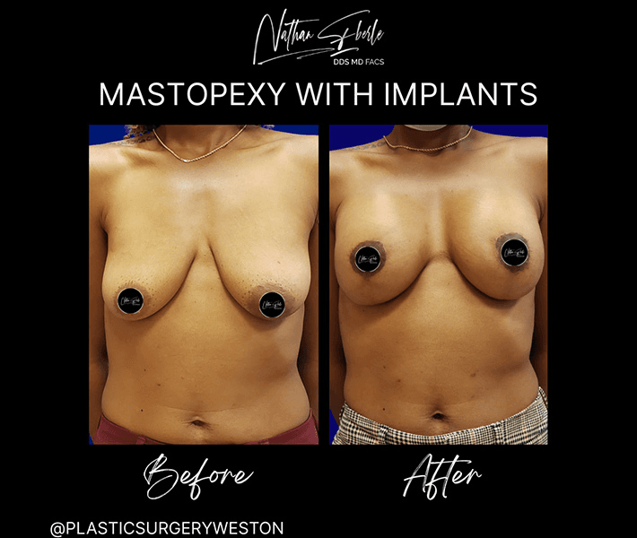 Breast Lift before and after case 23, actual patient at Weston Center for Plastic Surgery