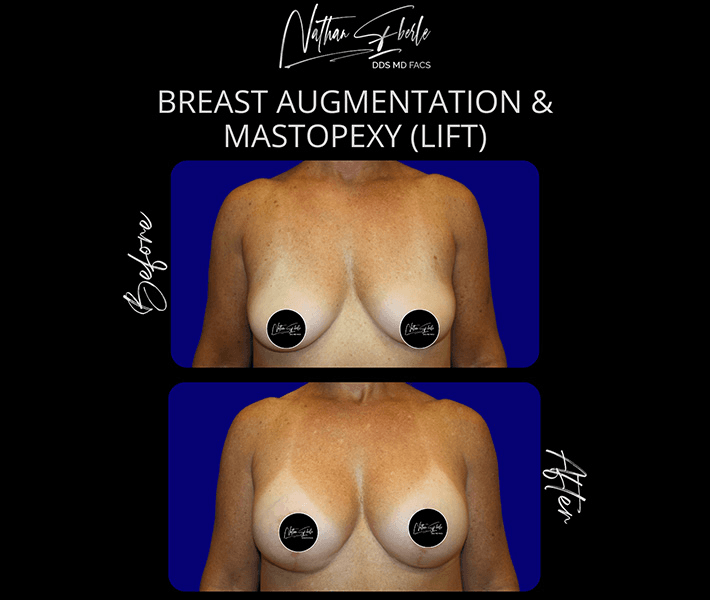 Breast Lift before and after case 8, actual patient at Weston Center for Plastic Surgery