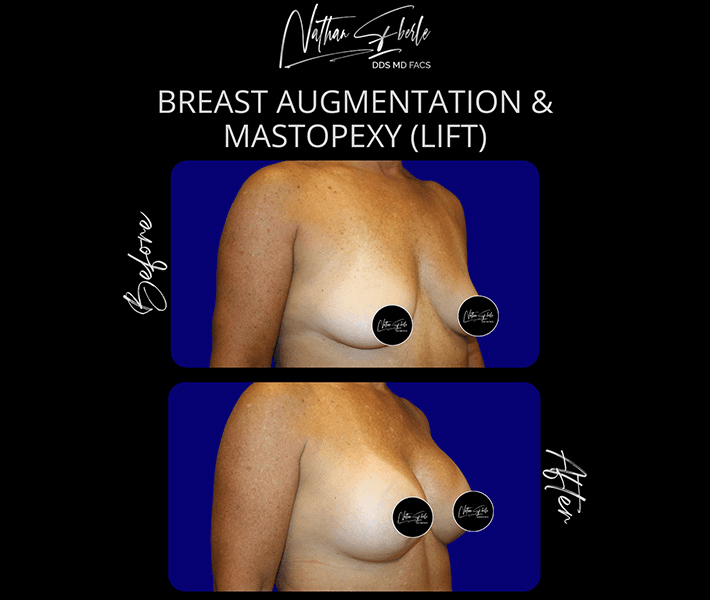 Breast Lift before and after case 9, actual patient at Weston Center for Plastic Surgery