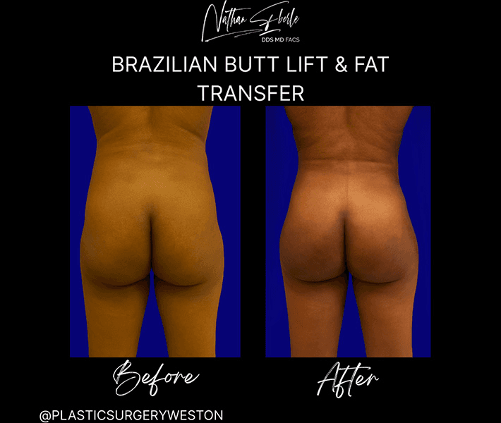Buttock Lift (BBL) before and after case 5, actual patient at Weston Center for Plastic Surgery