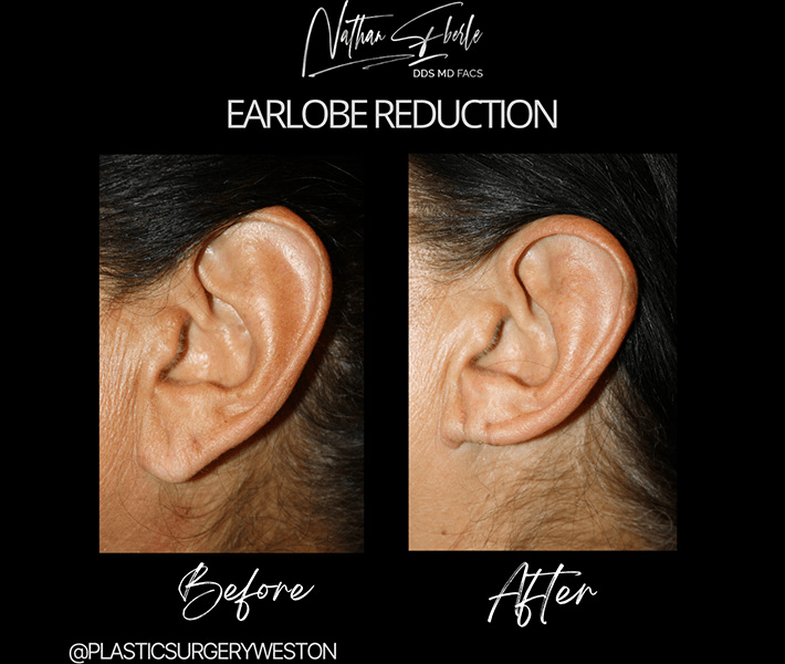 Earlobe Repair before and after case 18, actual patient at Weston Center for Plastic Surgery