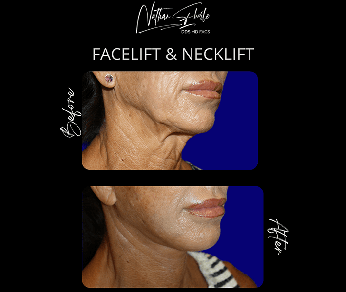 Facelift before and after case 11, actual patient at Weston Center for Plastic Surgery