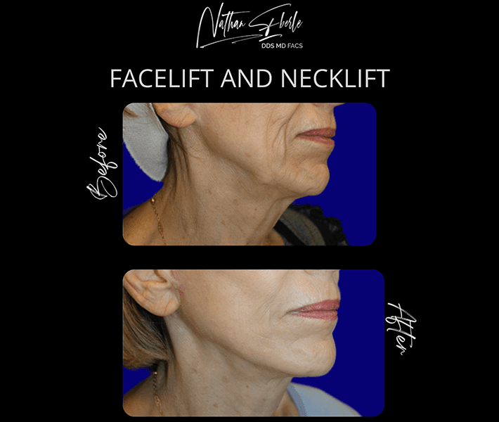 Facelift before and after case 12, actual patient at Weston Center for Plastic Surgery