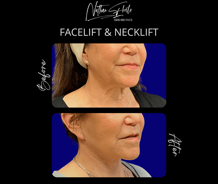 Facelift before and after case 14, actual patient at Weston Center for Plastic Surgery