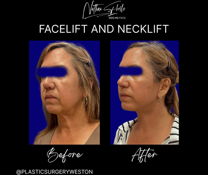 Facelift before and after case 21, actual patient at Weston Center for Plastic Surgery
