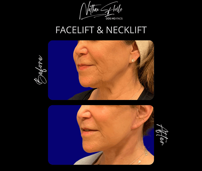 Facelift before and after case 26, actual patient at Weston Center for Plastic Surgery